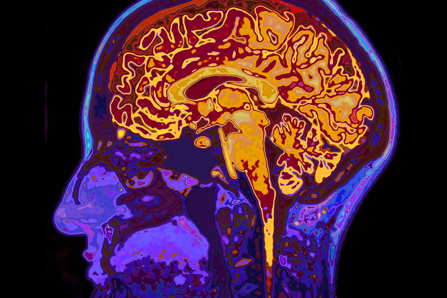A brain scan.