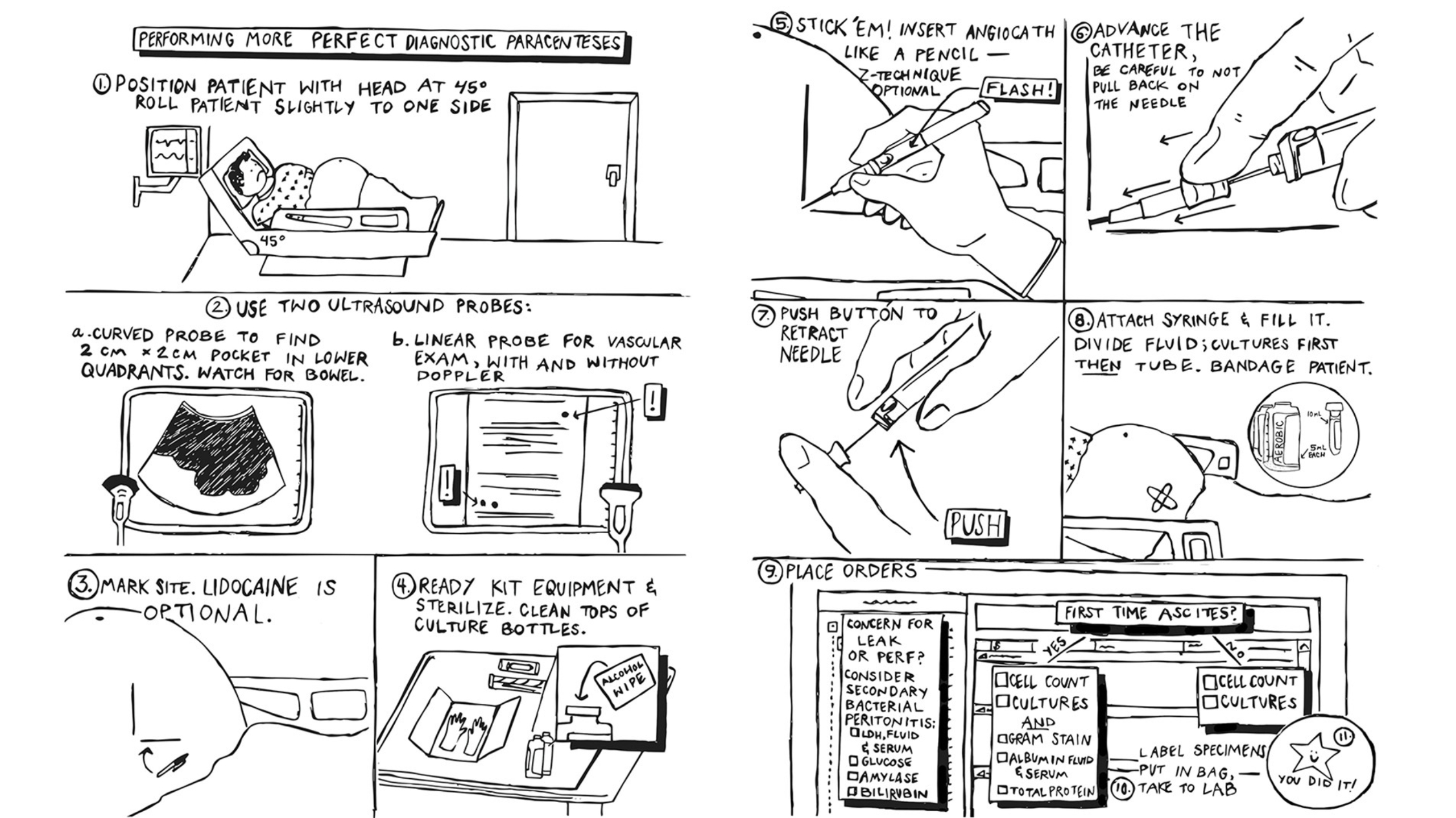 Drawn illustration of how to perform diagnostic paracentesis.