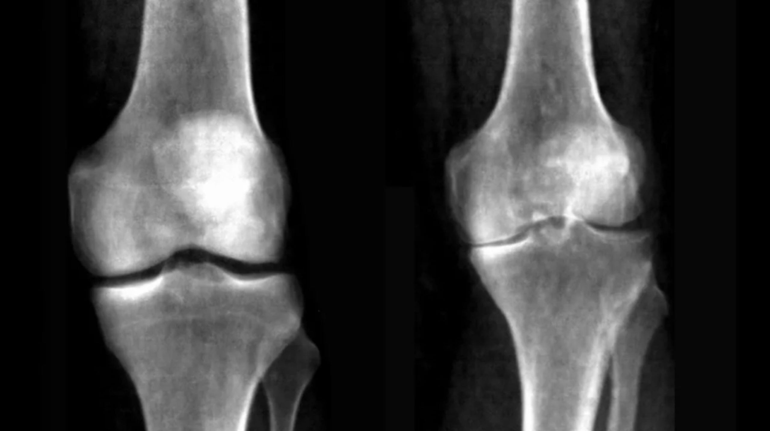 X-ray images of a healthy knee (left) compared to an individual with knee osteoarthritis (right).