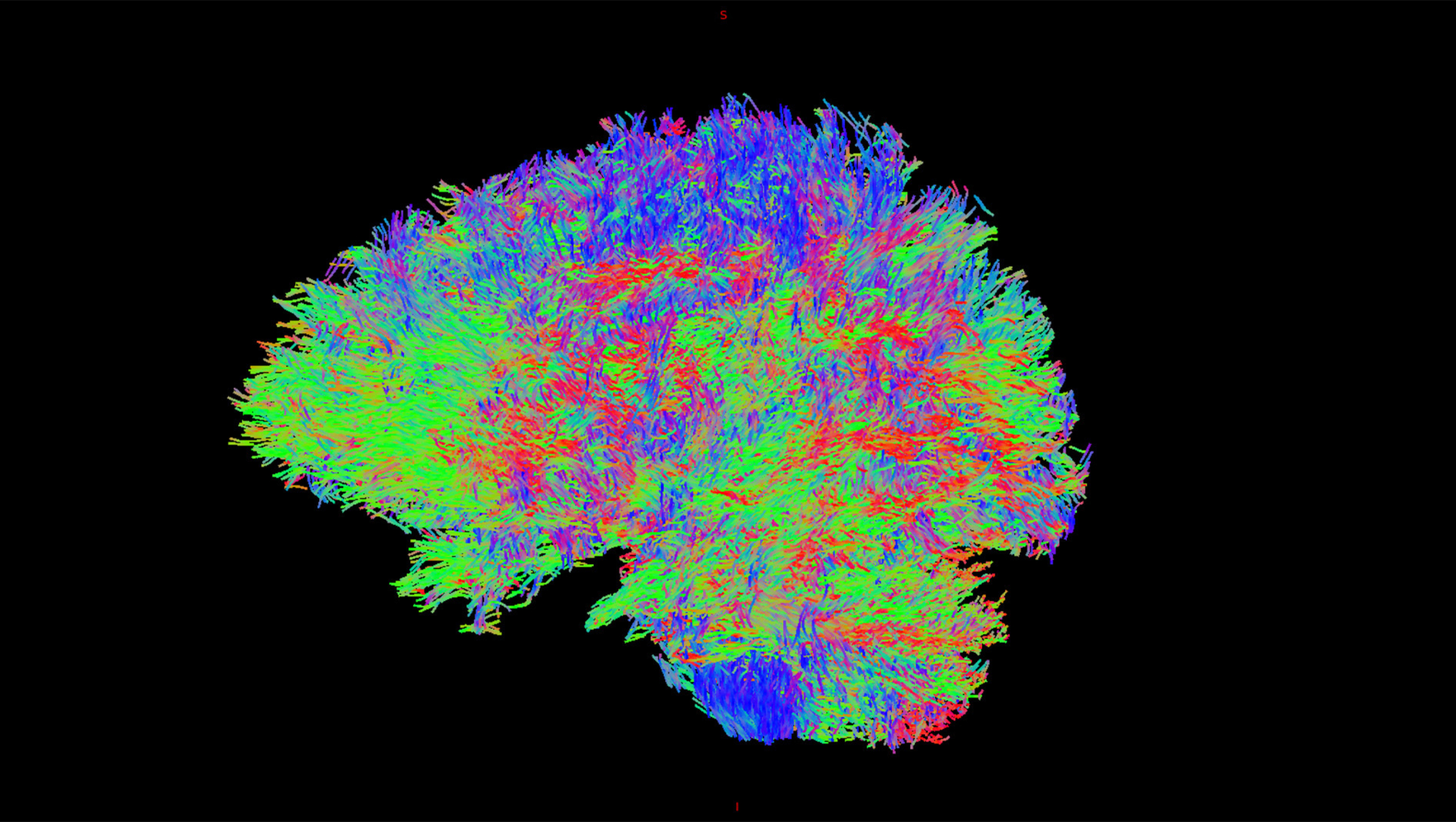 A diffusion weighted image shows the movement of water molecules within brain tissue. Courtesy: Mulva Clinic for the Neurosciences.